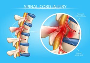 Spinal Cord Injury