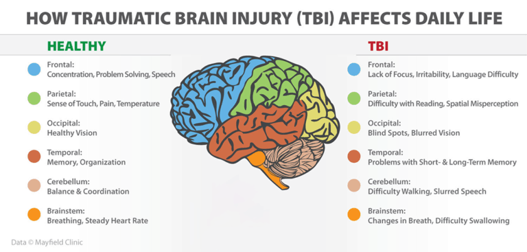 What are some long-term effects of TBI? - Quora