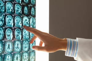 A doctor inspects the brain scans of a Tampa brain injury victim